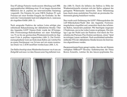 OffRoad™ Re-entry-Kathetersystem bei chronischer Okklusion der A. poplitea