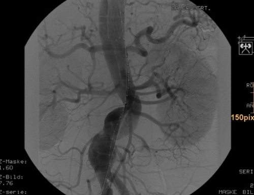 PETTICOAT concept employing a Jotec E-XL bare stent