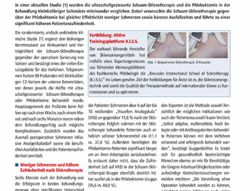 Schaum-Sklerotherapie versus Phlebektomie bei Varizen