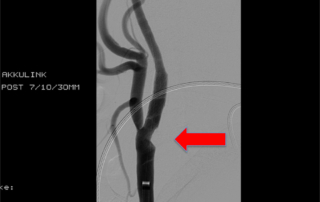Endovaskuläre Behandlung der Karotis