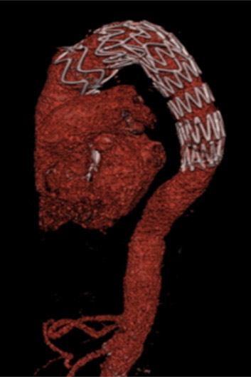 Radiologische Intervention.